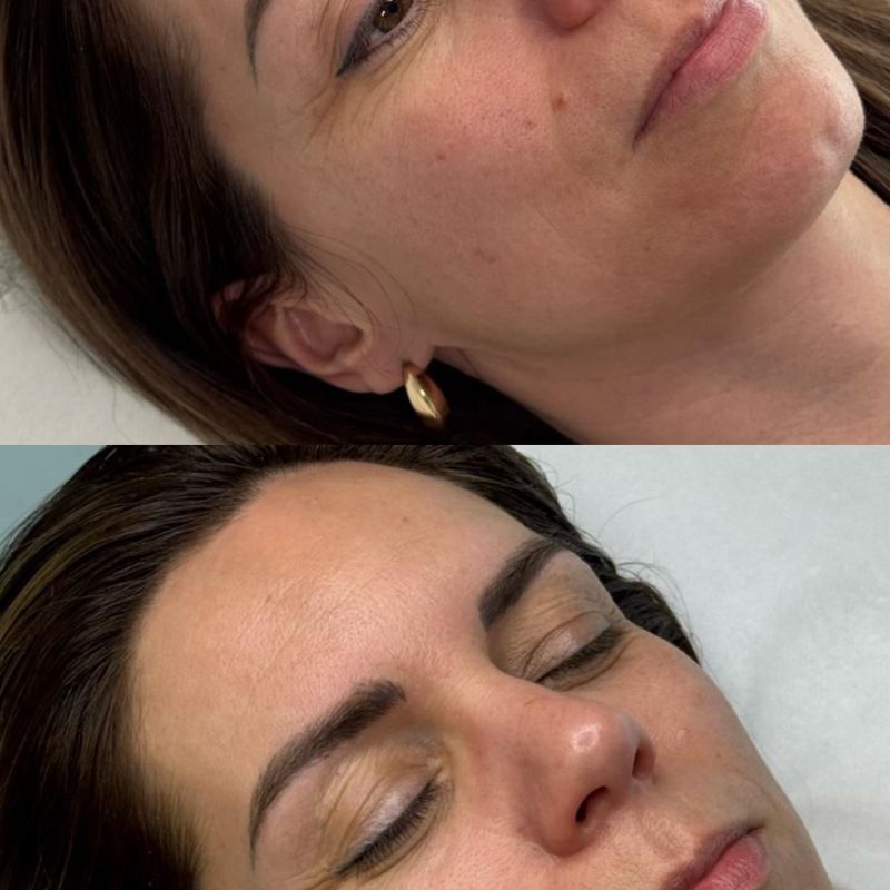 MICRONEEDLING